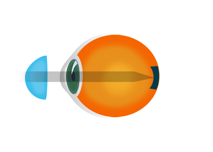 Hyperopian korjaus piilolinsseillä