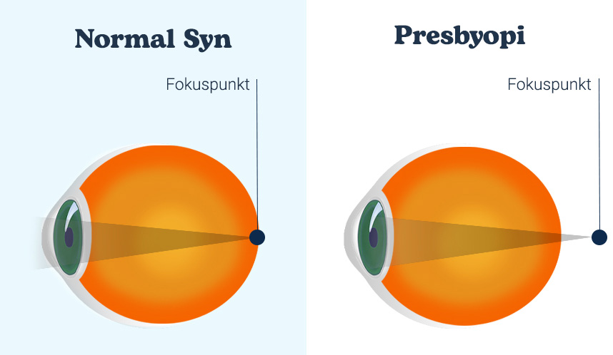 kuva tarkennuspisteestä normaalissa silmässä ja presbyopiasta kärsivässä silmässä