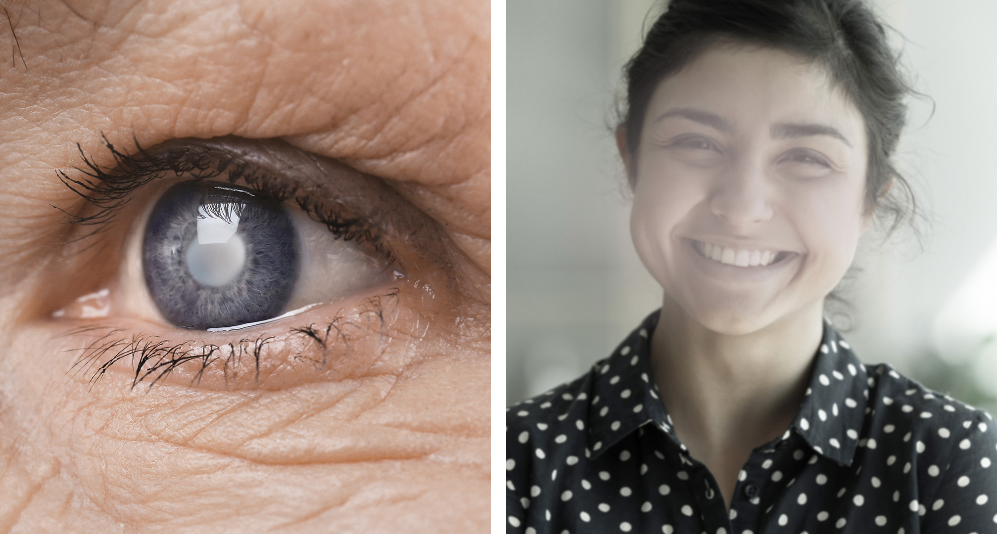 Harmaakaihi voi näkyä valkoisena tai samentuneena levynä mykiössä (vasemmalla). Ajan myötä ne voivat johtaa näön sumentumiseen, sumuiseen tai utuiseen näköön (oikealla).