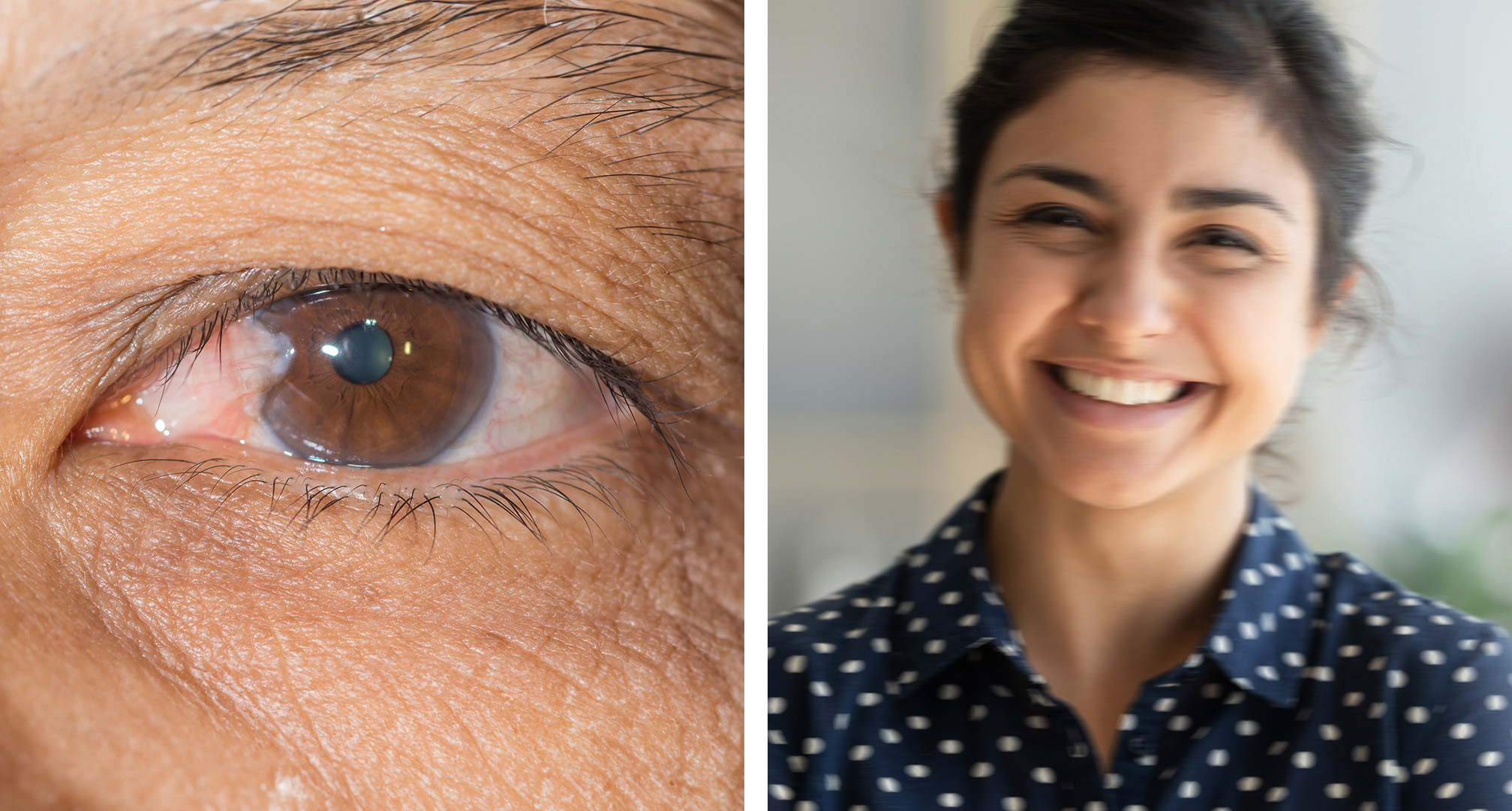 Pterygium on kiilamainen kasvain sidekalvolla, joka ulottuu sarveiskalvolle (vasemmalla). Äärimmäisissä tapauksissa, jos pterygium laajenee pupillin yli, se voi estää tai sumentaa näköä (oikealla).