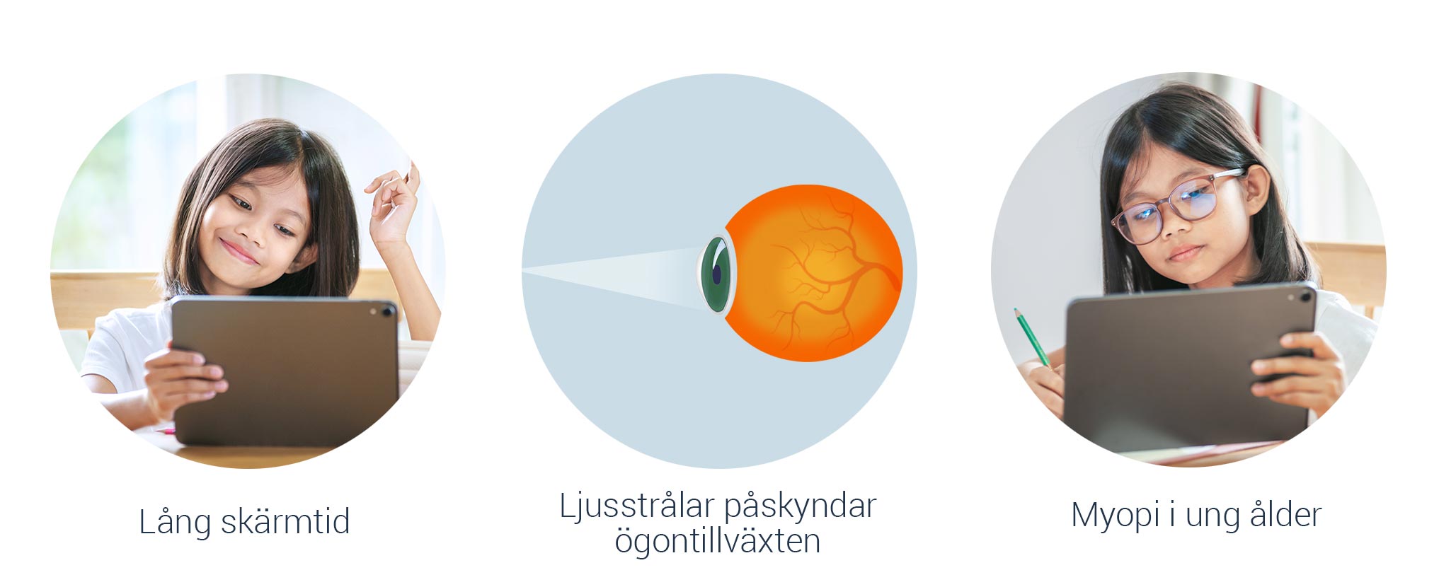Mikä aiheuttaa likinäköisyyttä (myopiaa) lapsilla?